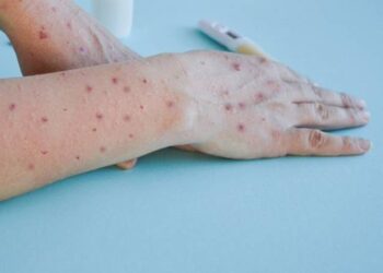 Viruela del mono, emergencia de salud pública internacional: OMS