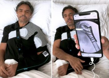 Eugenio Derbez comparte detalles sobre fractura de brazo