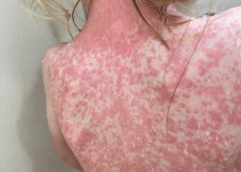 Salud aplica más de 11 millones de vacunas contra el Sarampión.