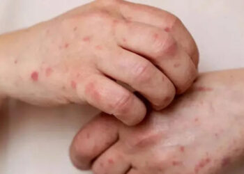 Detectan un caso sospechoso de sarampión en la UNAM